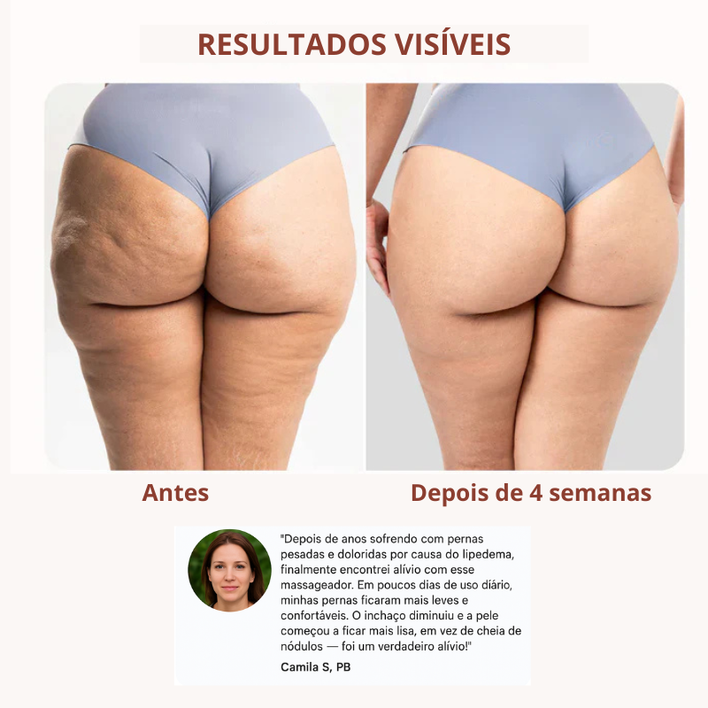 Lymfedrænagerulle – Lymfemassageapparat til lipødem og cellulite