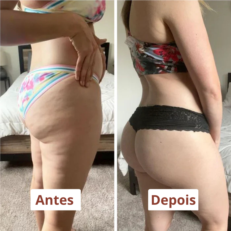 Lymfedrænagerulle – Lymfemassageapparat til lipødem og cellulite
